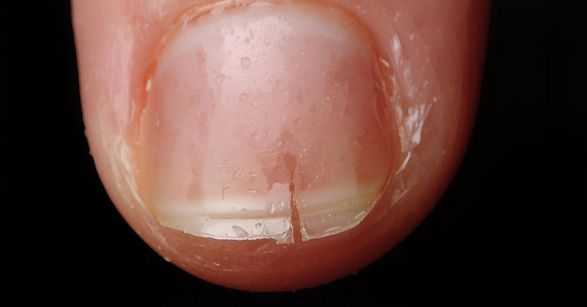 Nagel close-up met allergie en scheur, als waarschuwing van allergische reacties op gellak ingrediënten zoals HEMA.